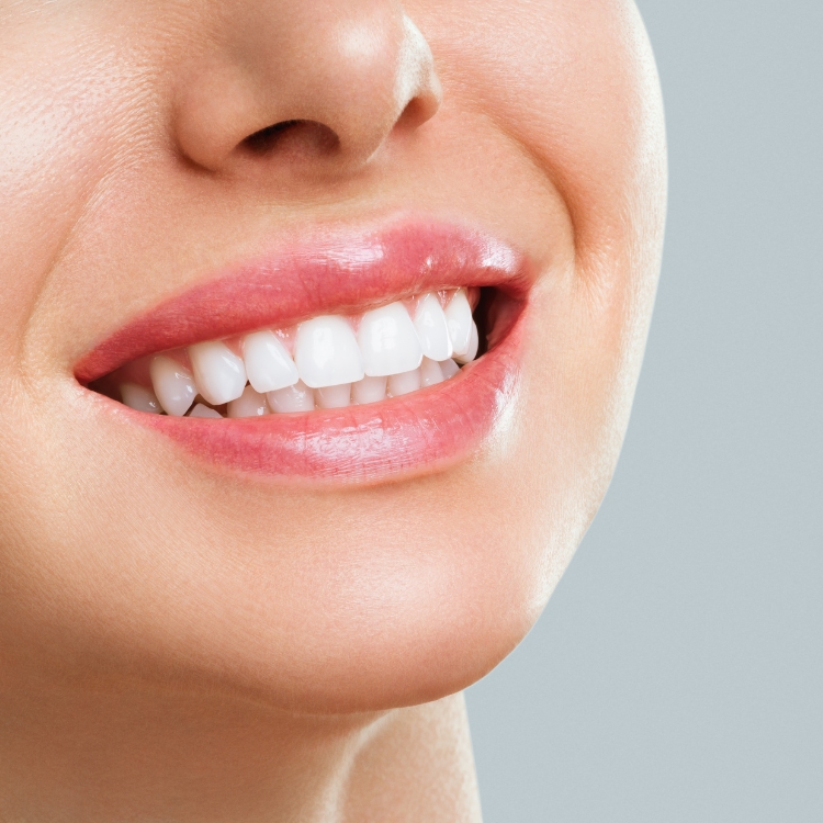 dental whitening